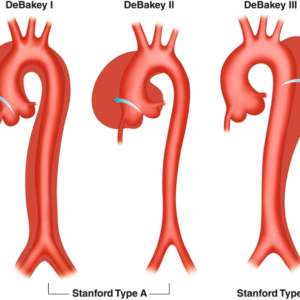 Aortic Dissections