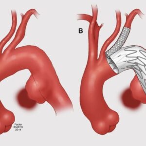 Penetrating Atherosclerotic Ulcers