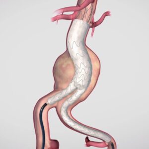 Aortic Aneurysms